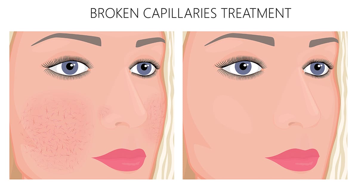 illustration-capillaries-broken-before-after