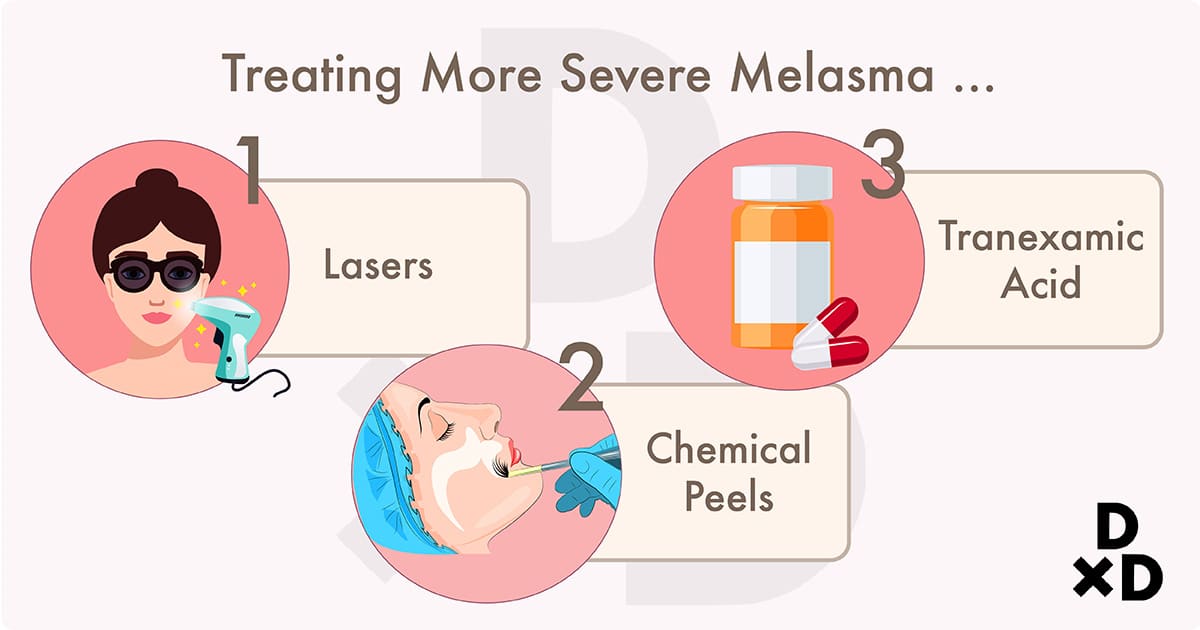 illustration on treatment types for more severe melasma