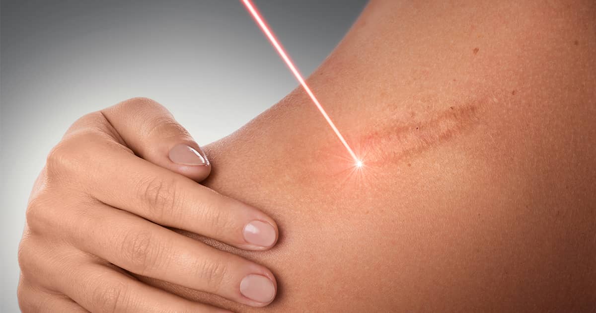 female-scars-laser-treatment