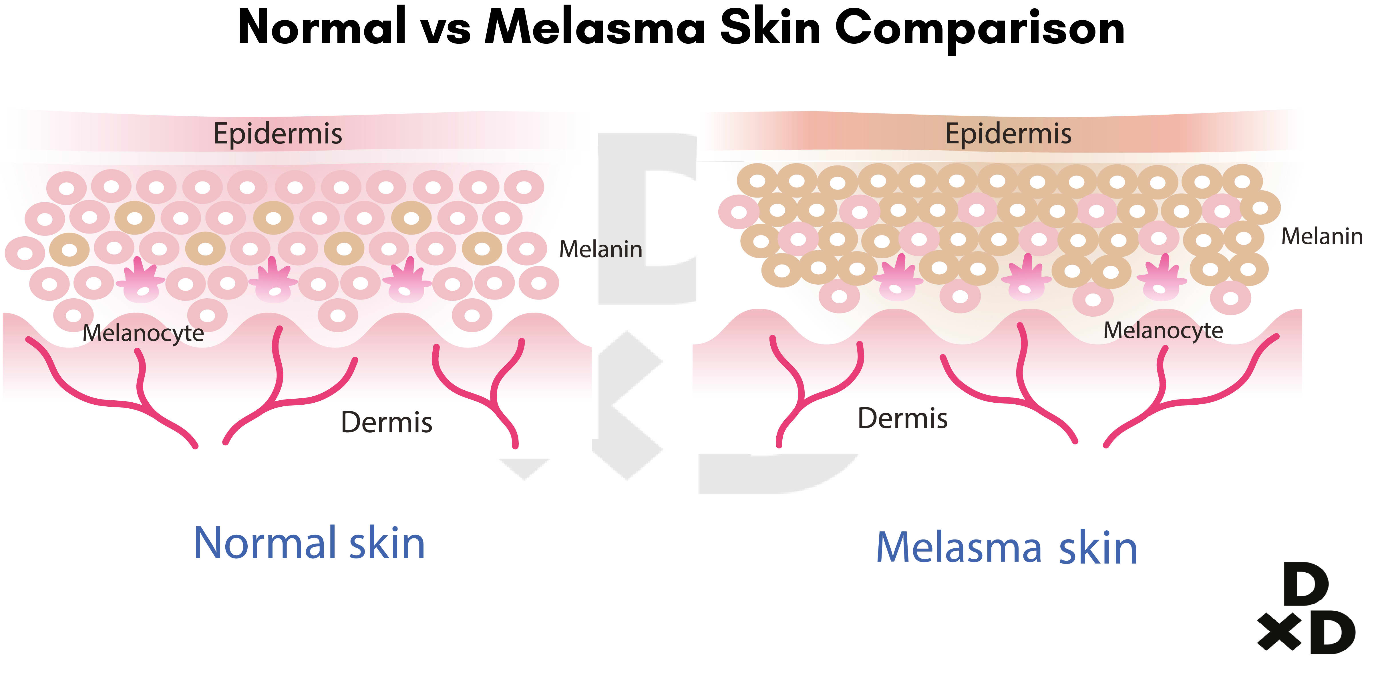 normal-melasma-skin-comparison-illustration