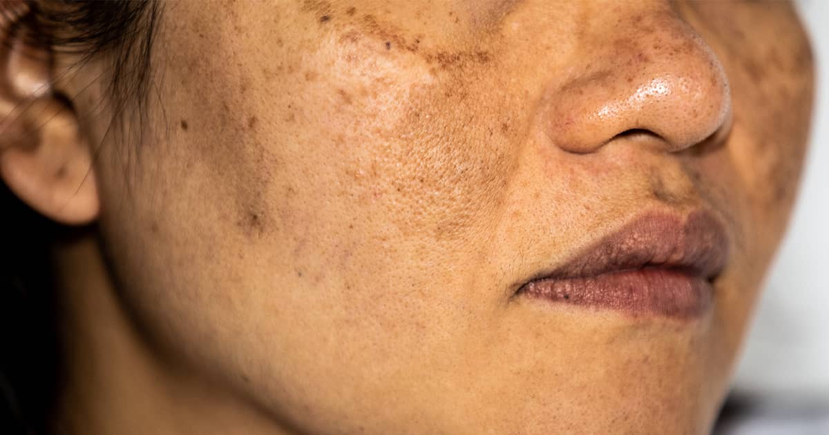 female-melasma-photo