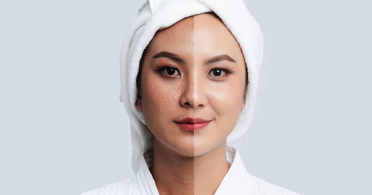 asian-woman-melasma-treatment-comparision