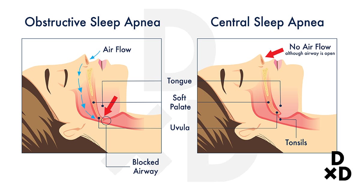 illustration of the differences of obstructive and central sleep apnea