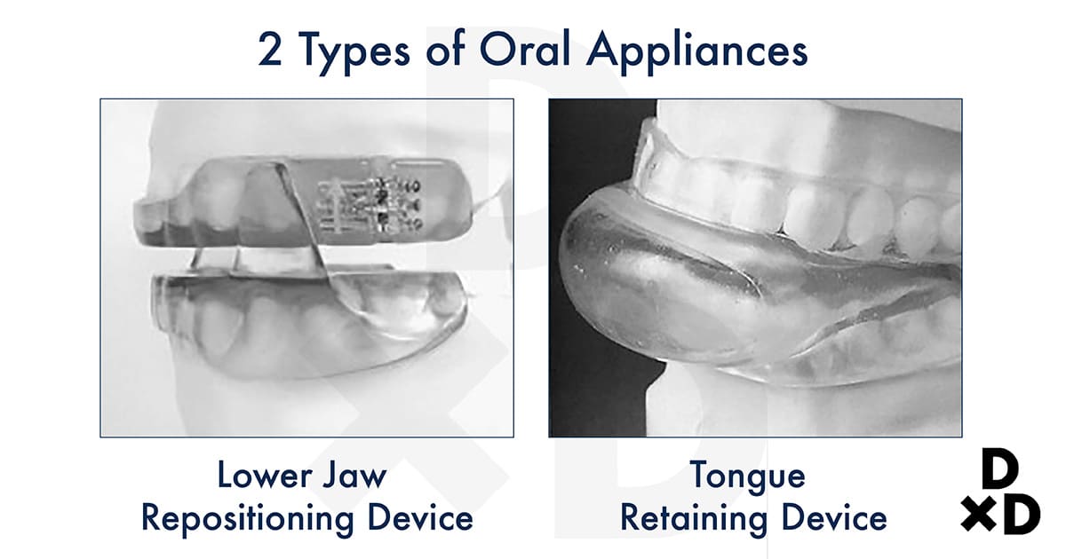 two types of oral appliances for sleep apnea