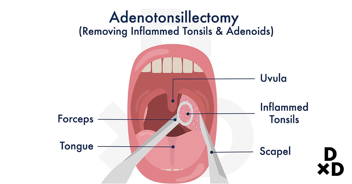 illustrating the removal of tonsils and adenoids