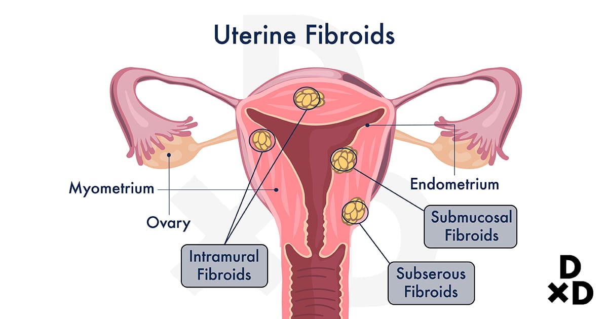 illustration-of-the-different-types-of-fibroids