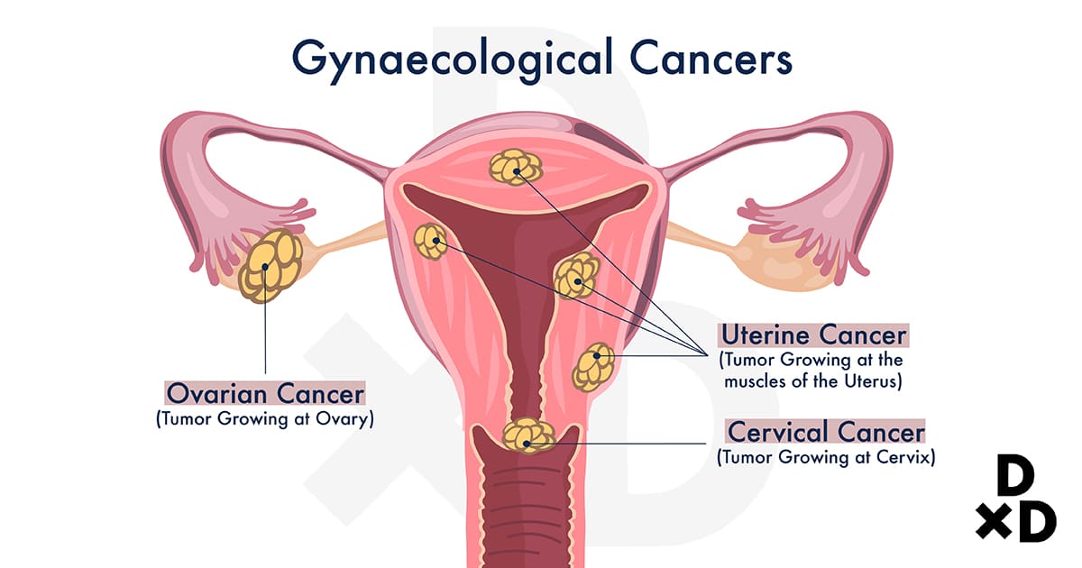 illustration-of-gynaecological-cancers