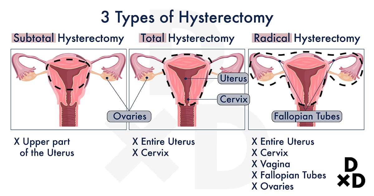 illustration-on-the-types-of-hysterectomy