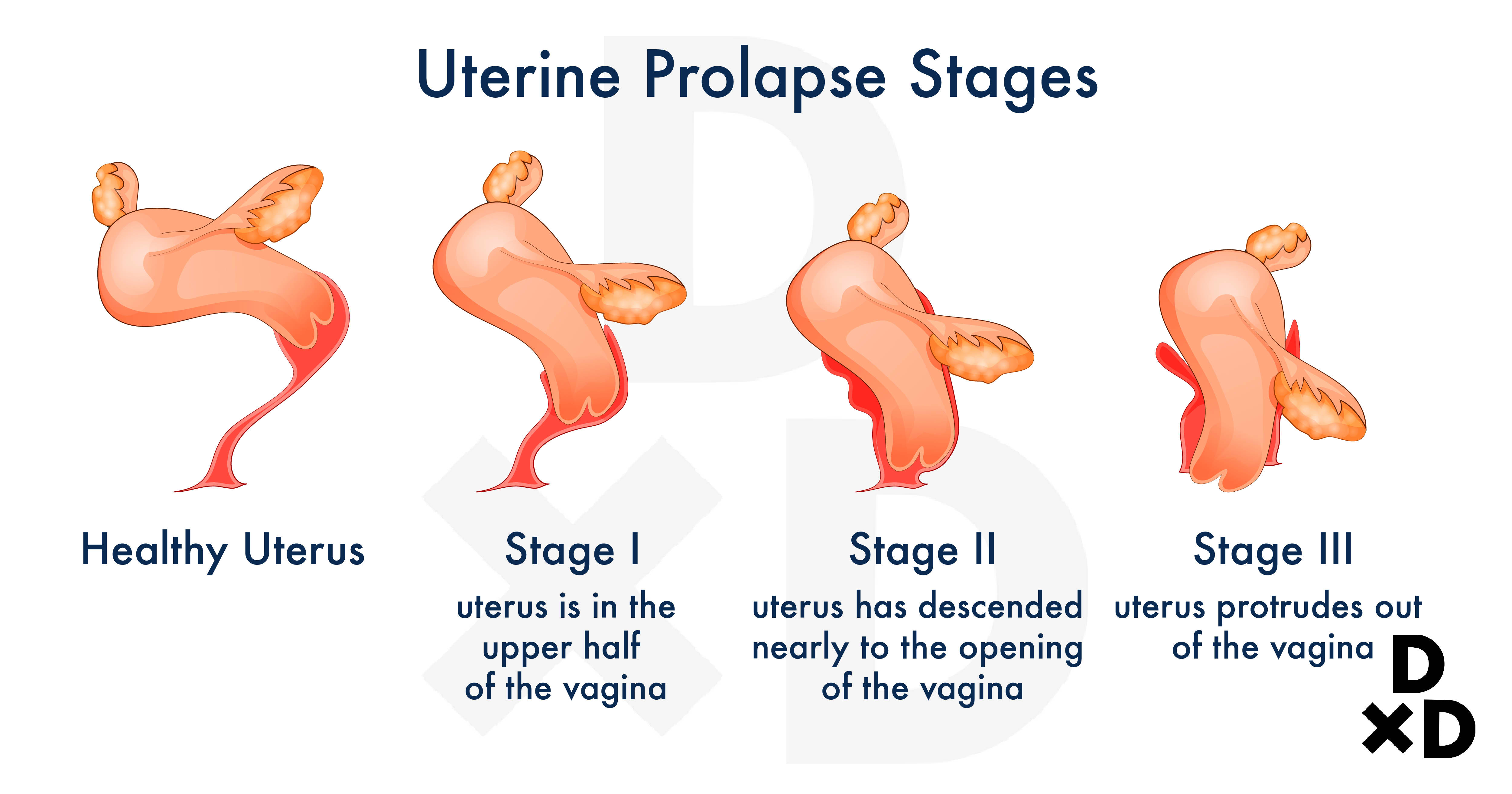 uterine-prolapse-stages