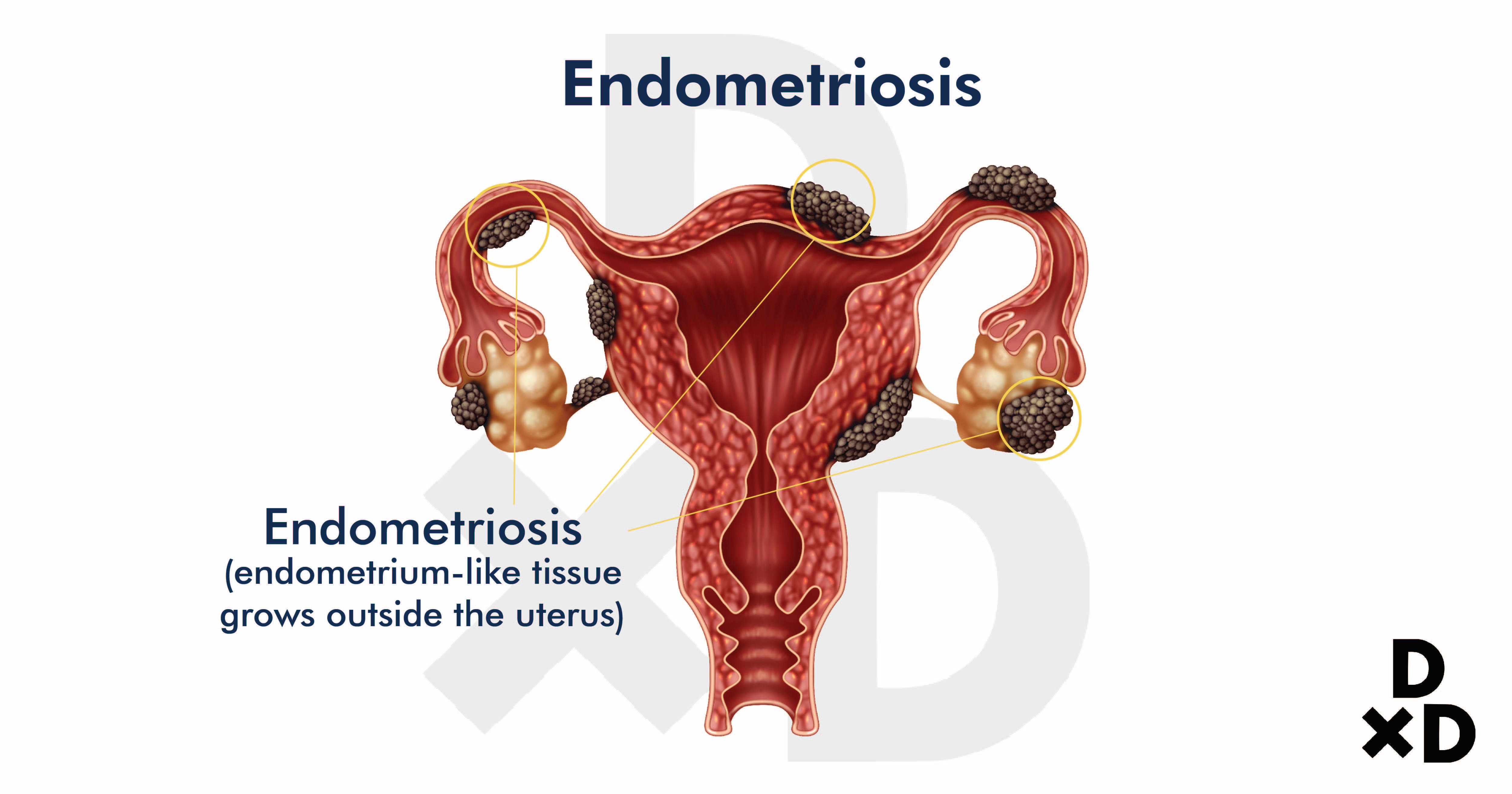 endometriosis