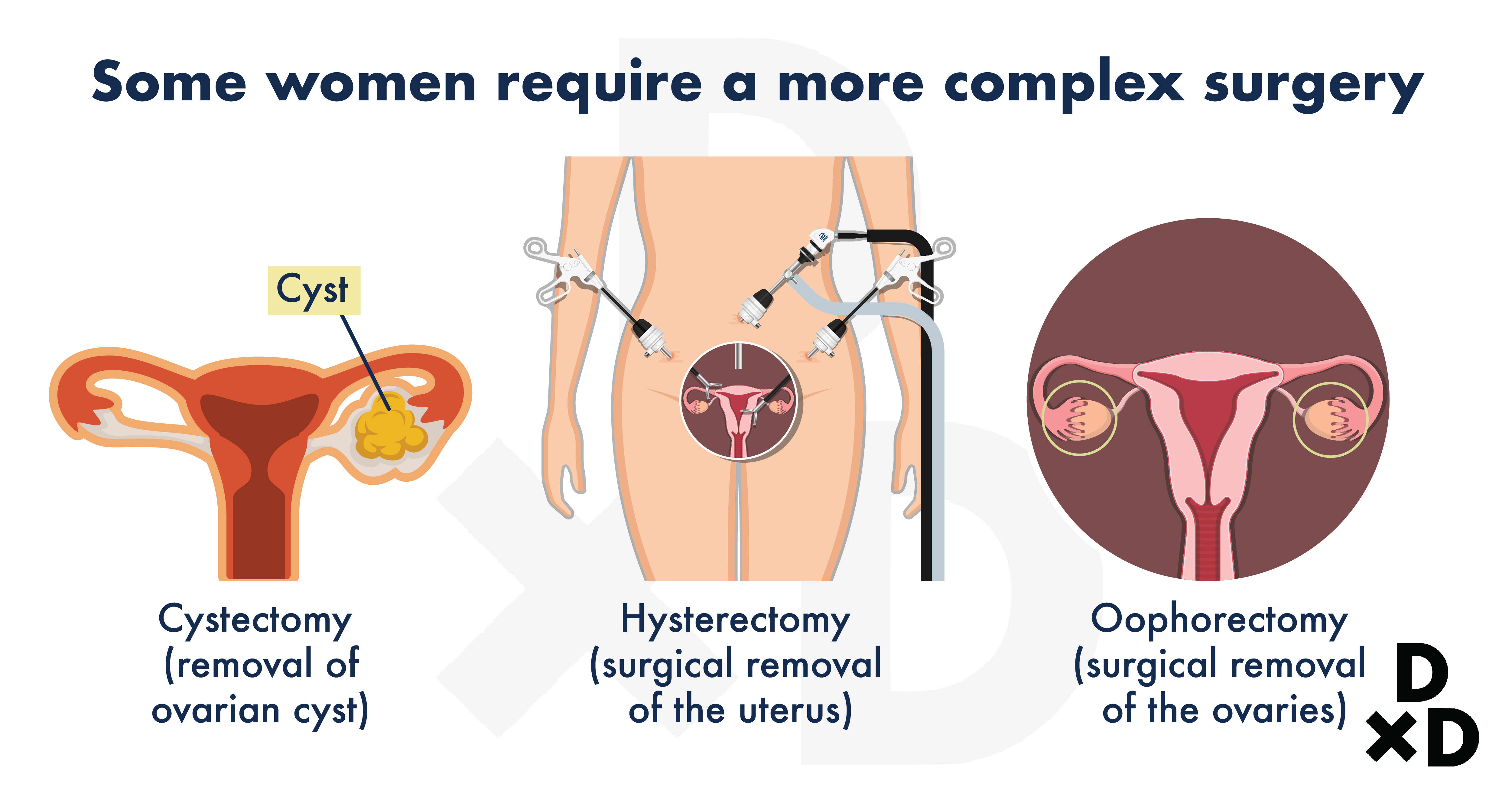 complex-surgeries-for-endometriosis