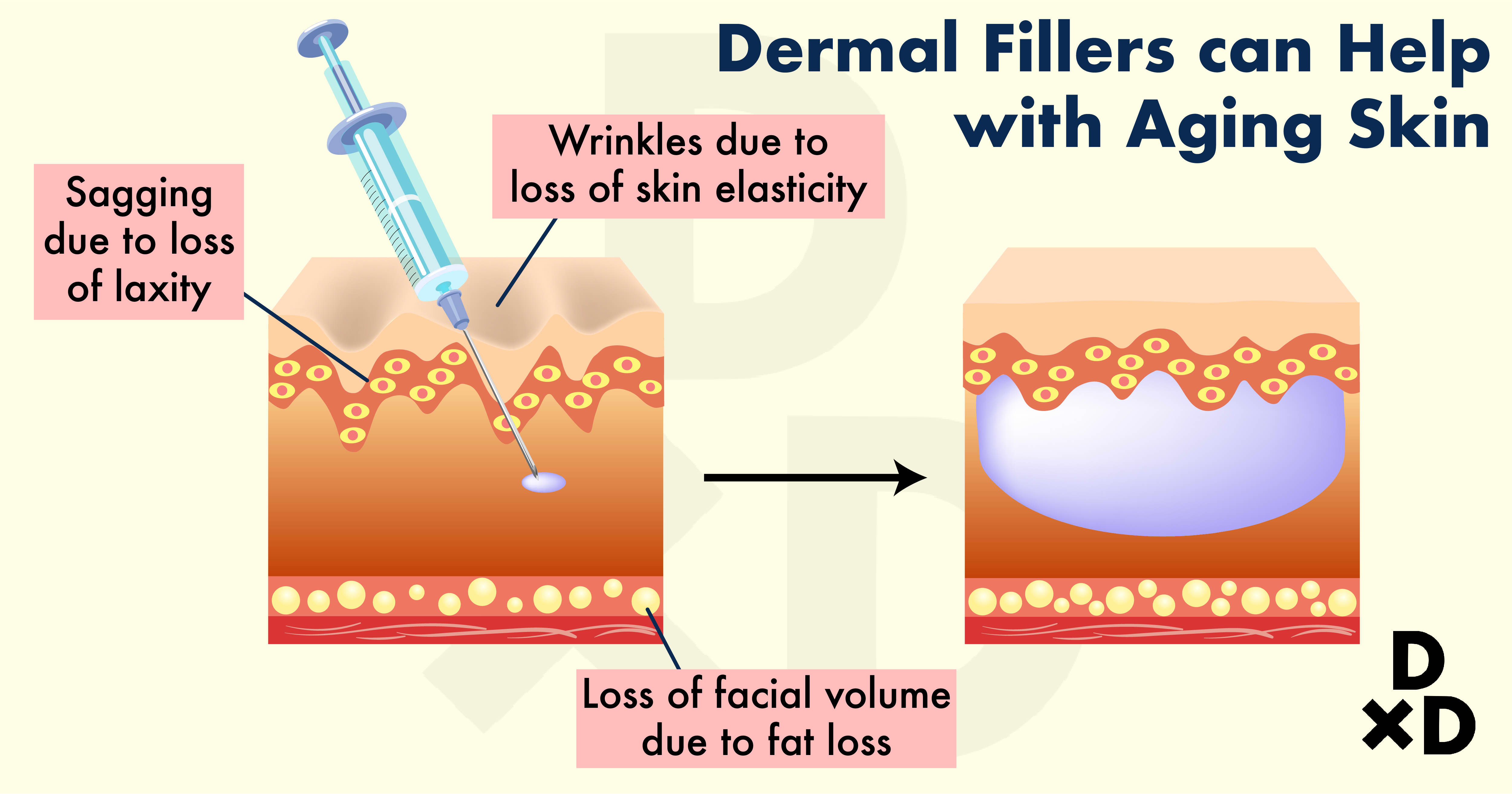 botox-vs-filler_how-do-dermal-fillers-work