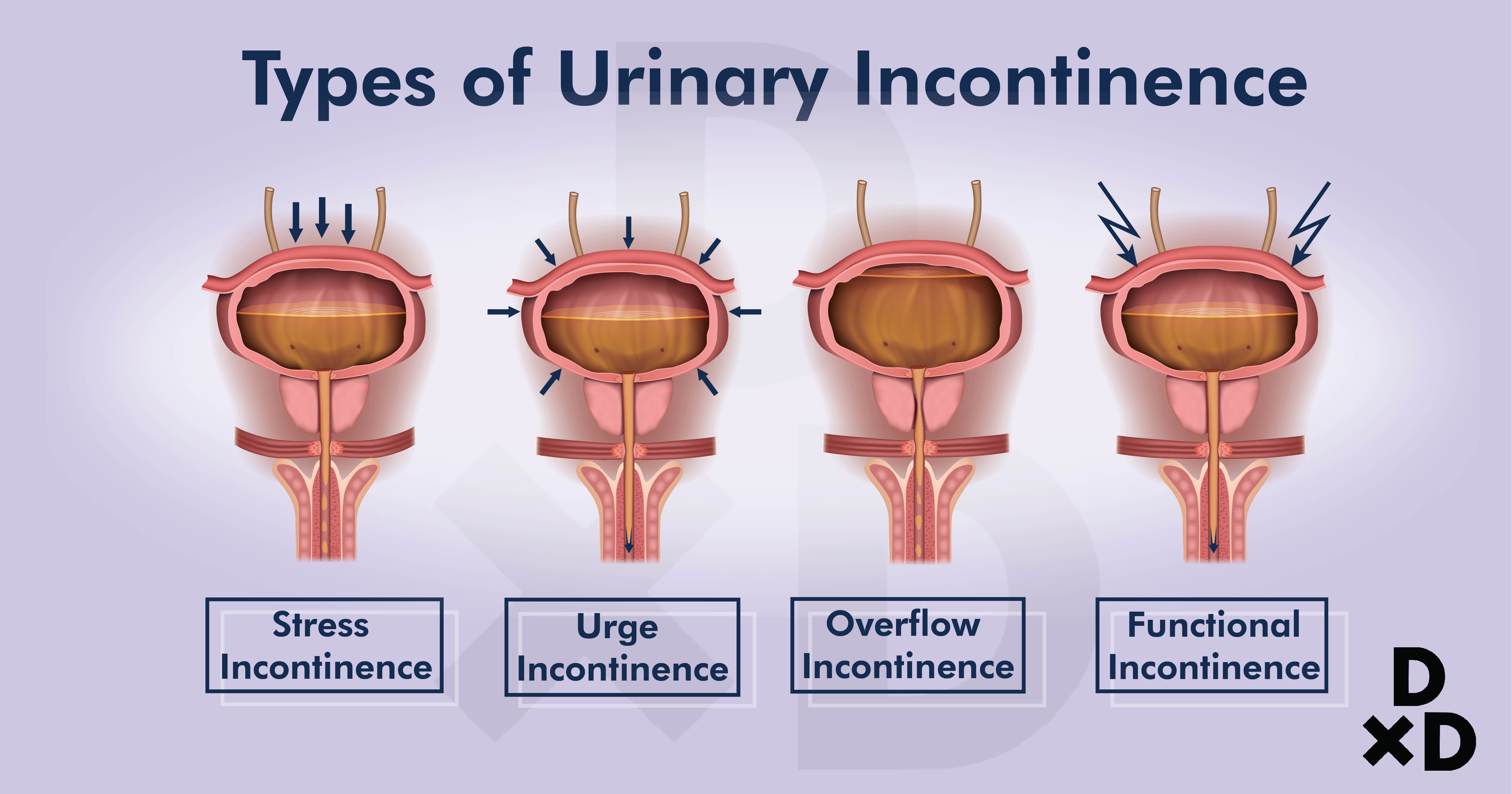 Common Cause Of Stress Urinary Incontinence