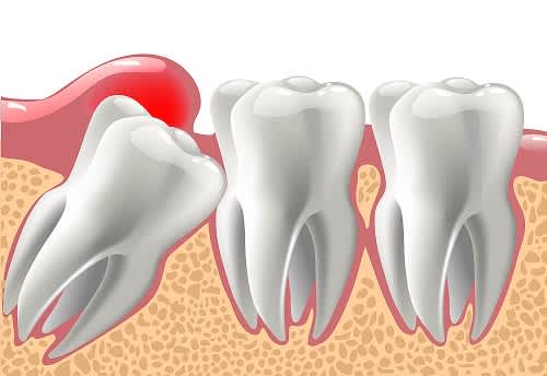 What are the pros and cons of extracting asymptomatic, fully impacted wisdom teeth prior to wearing braces?