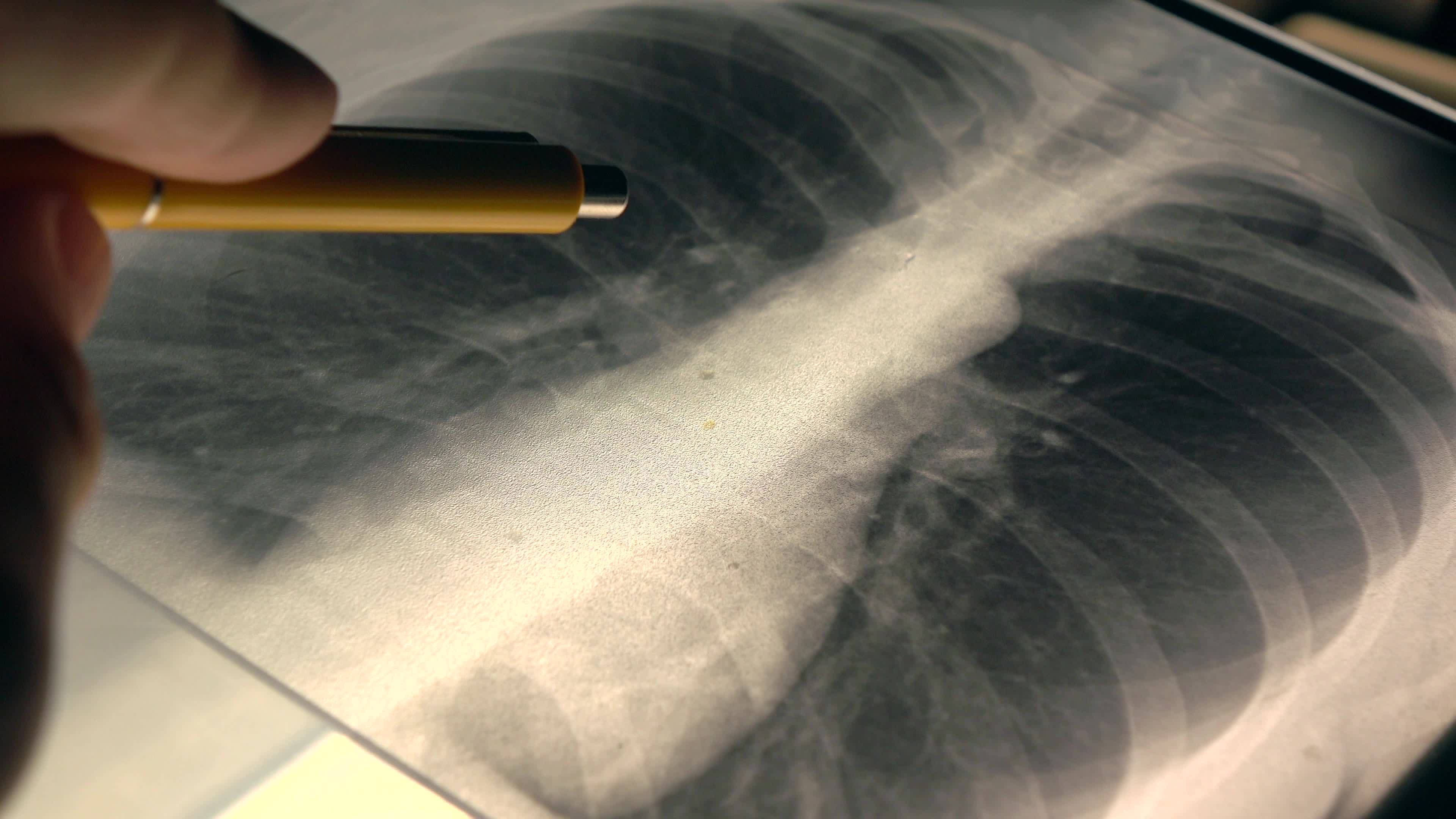 chest x ray