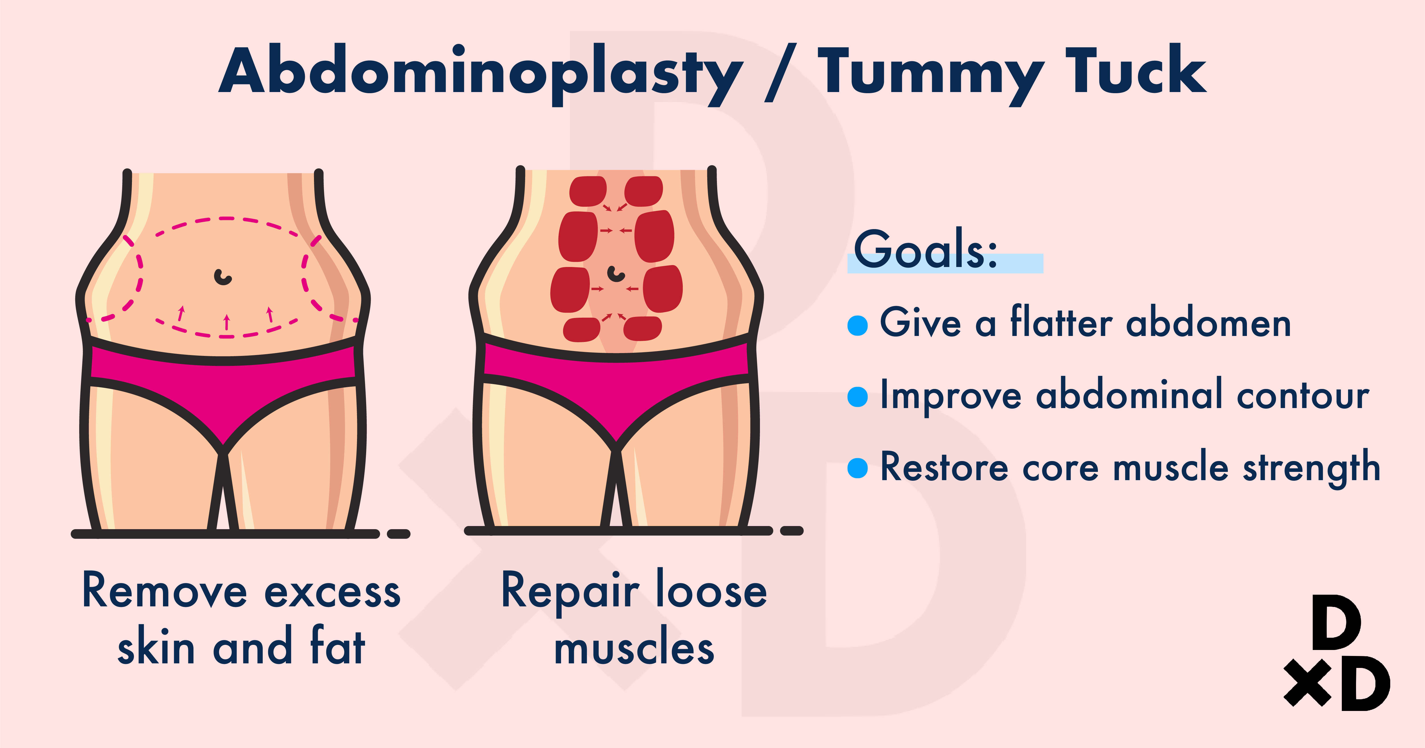 abdominoplasty-what-is-tummy-tuck