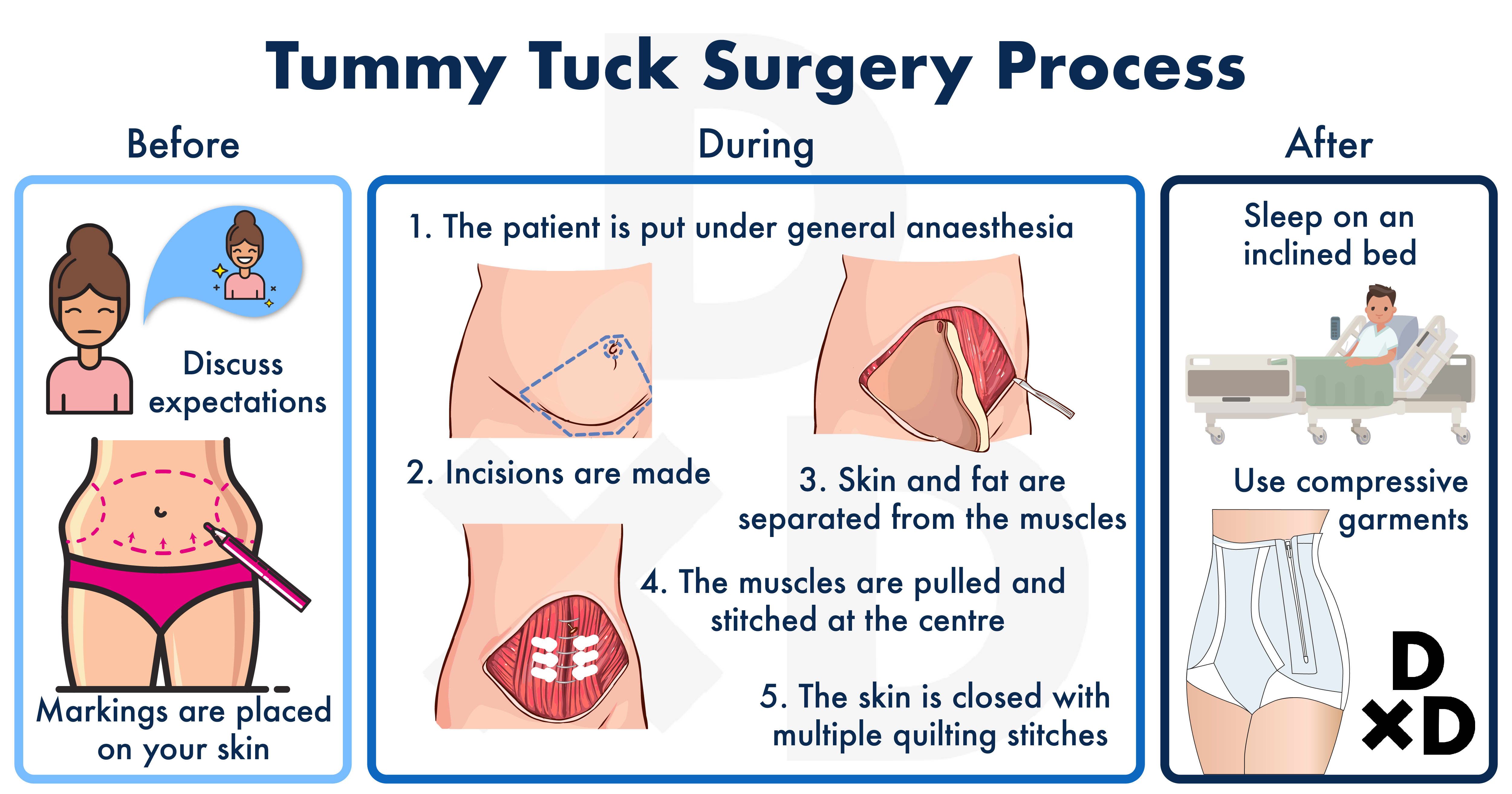 abdominoplasty-tummy-tuck-journey