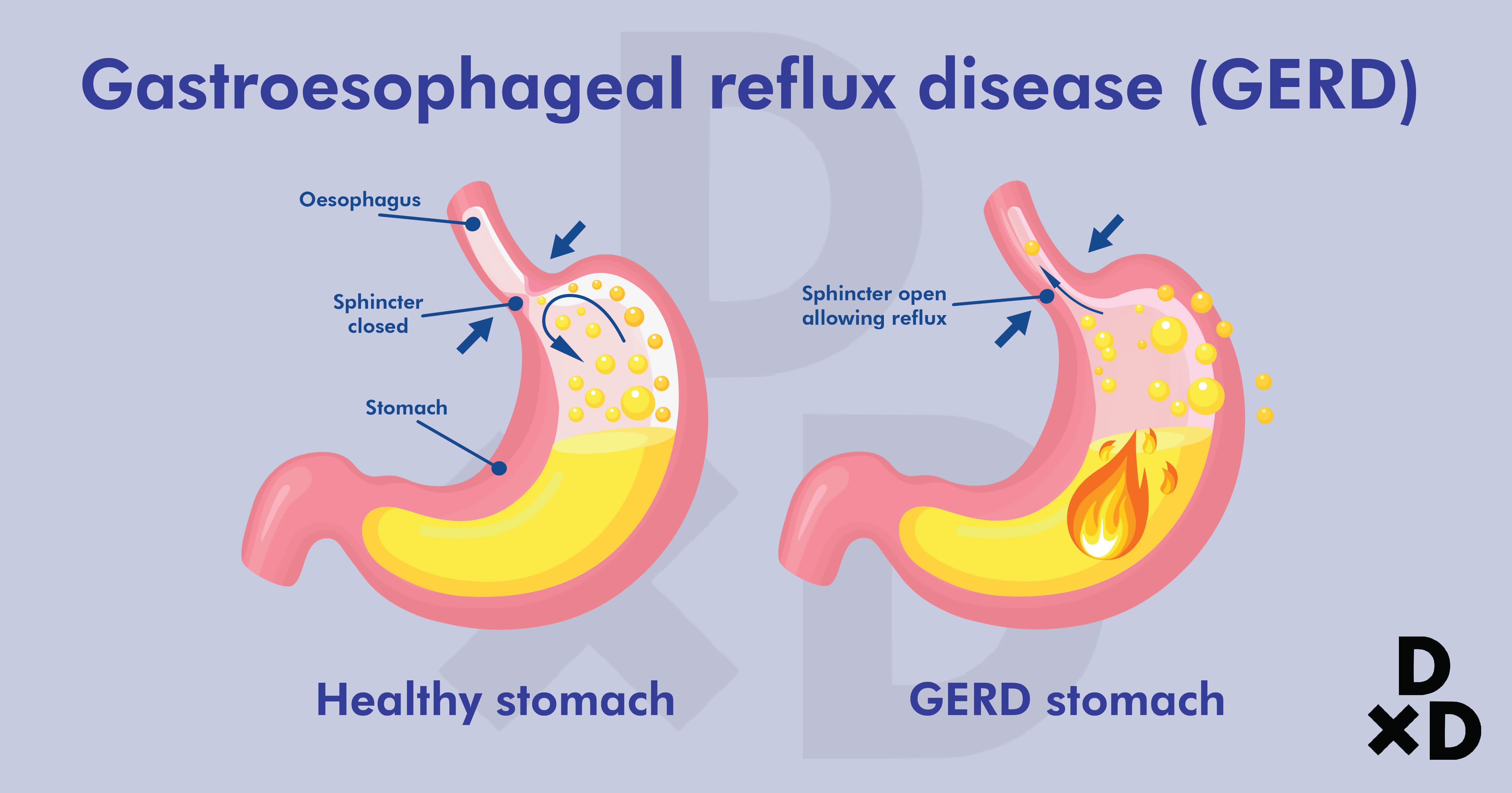 gastroesophageal-reflux-disease