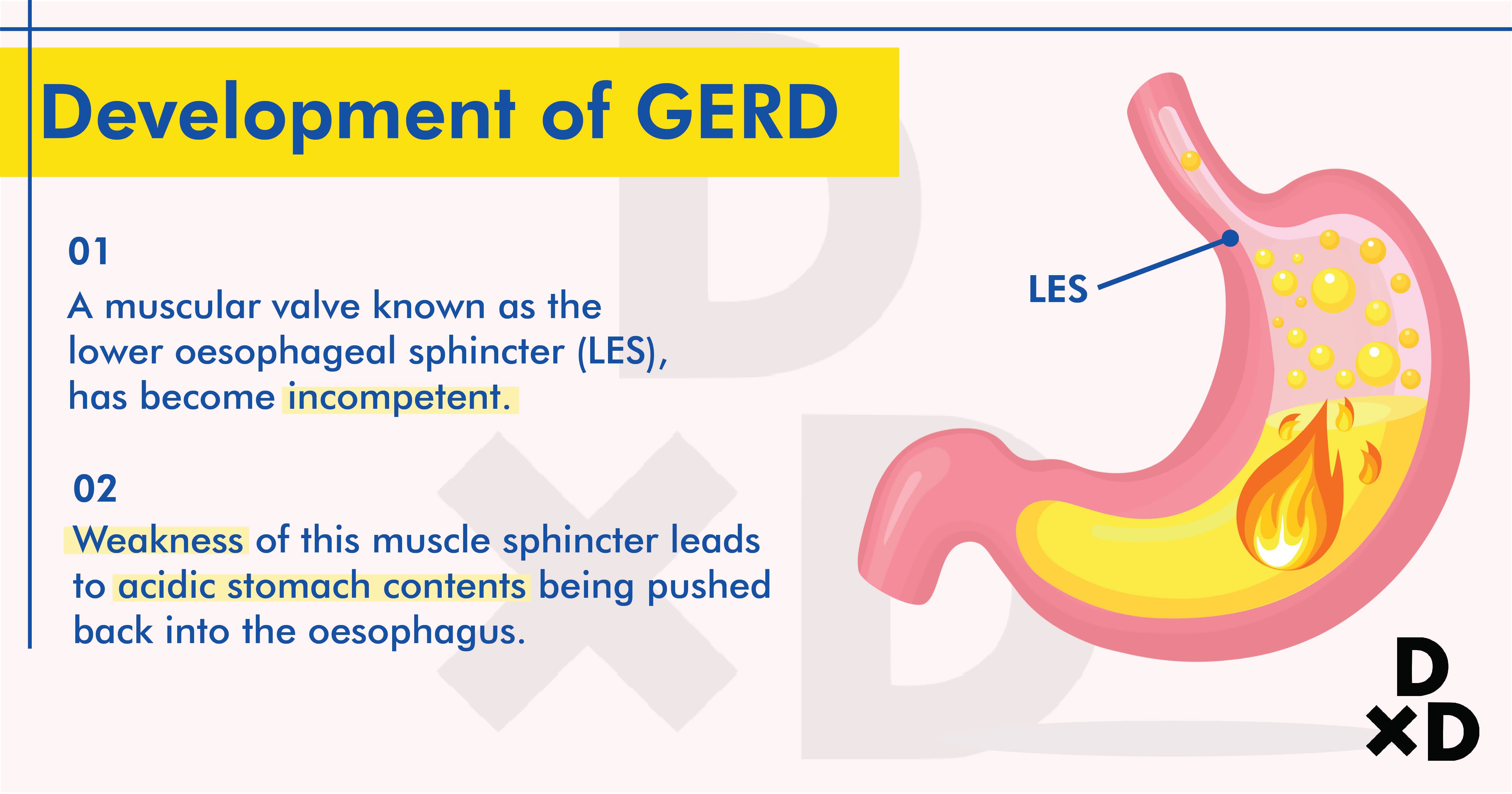 development-of-gerd