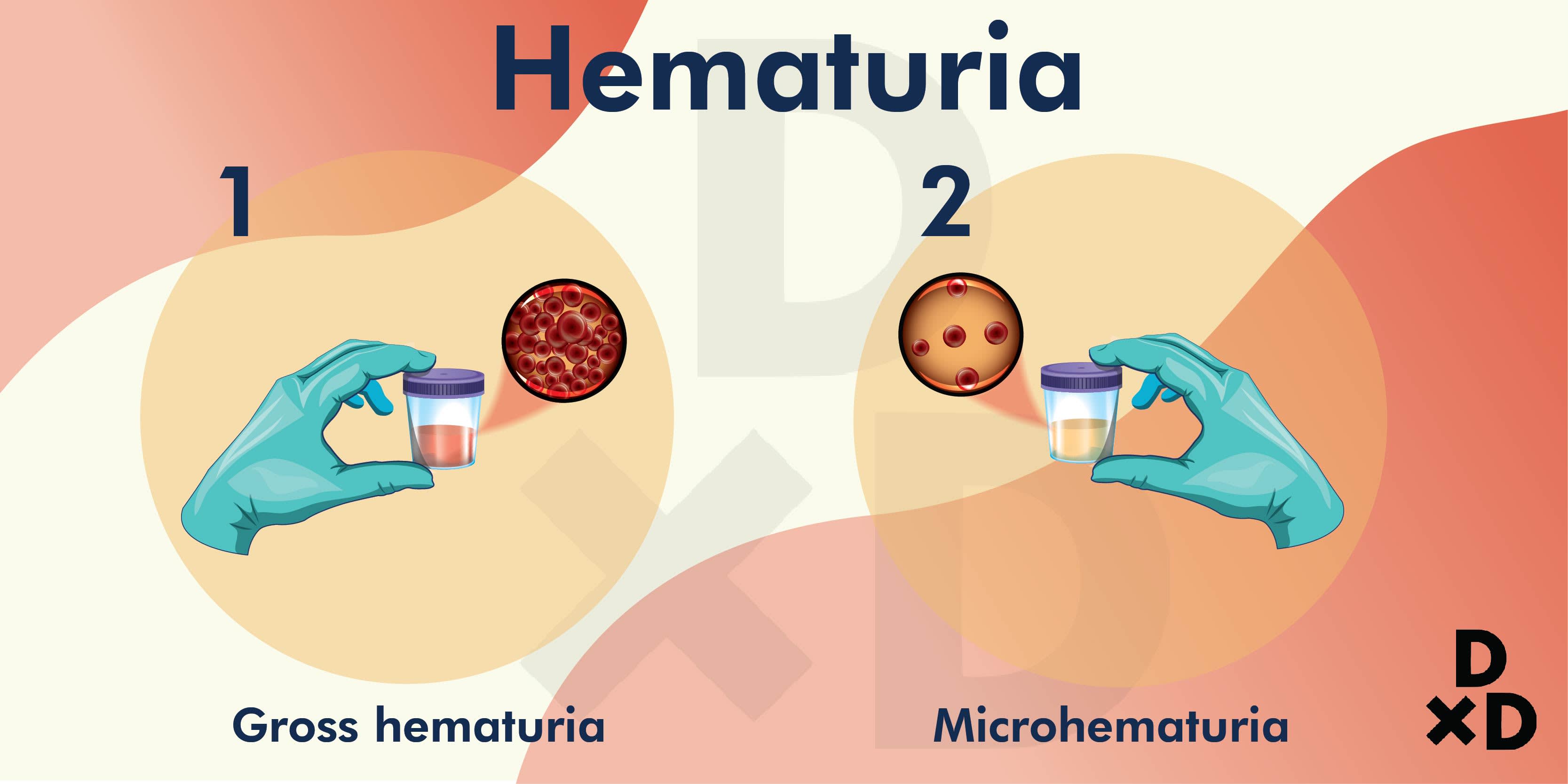 hematuria