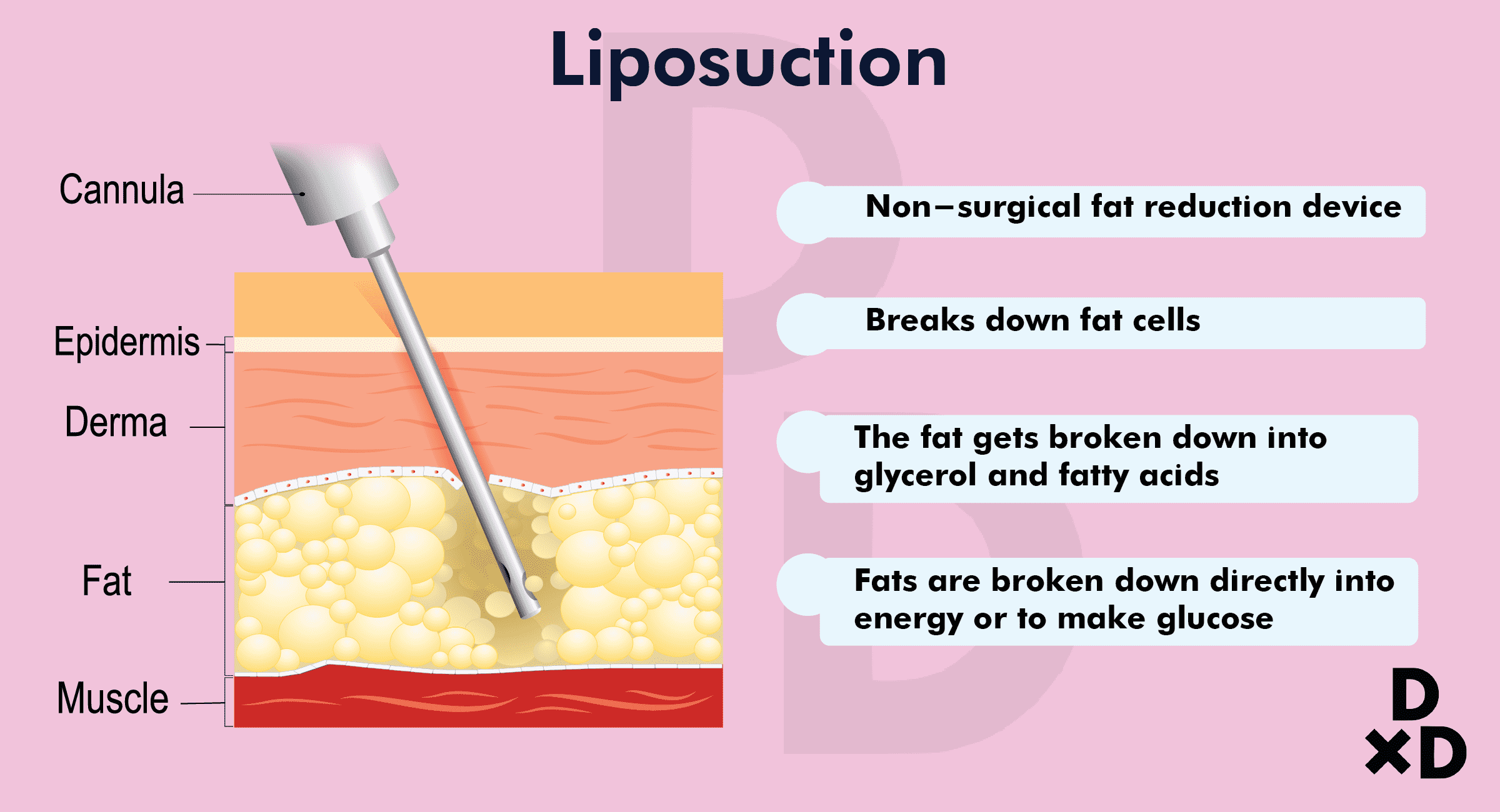 liposuction