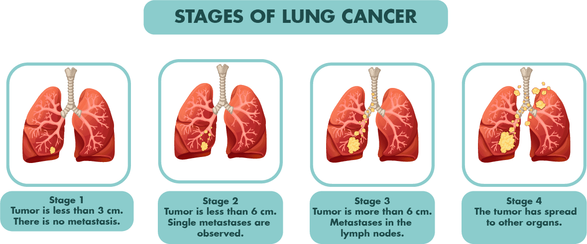 stages-lung-cancer-caregiver