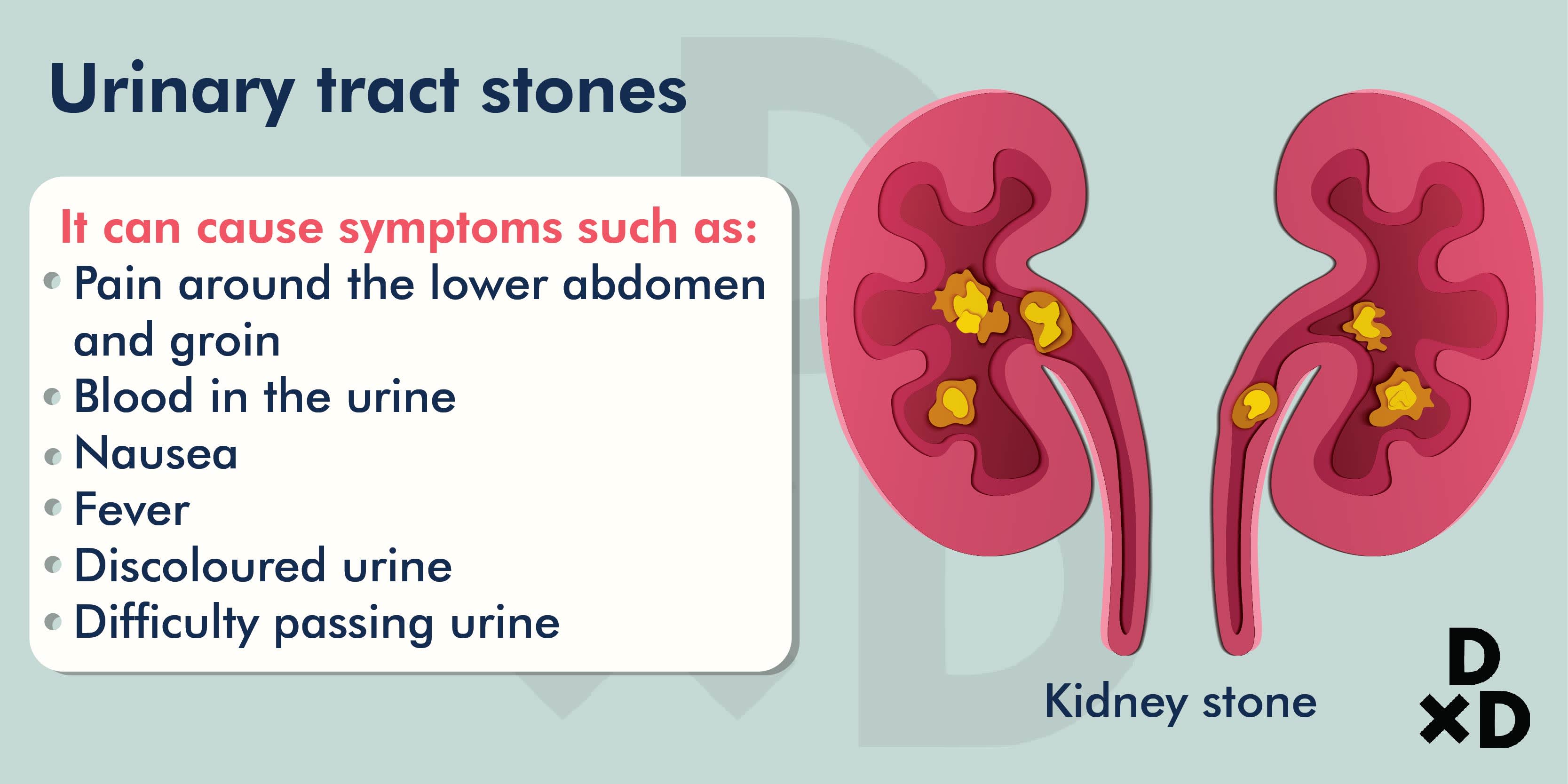 urinary-tract-stones