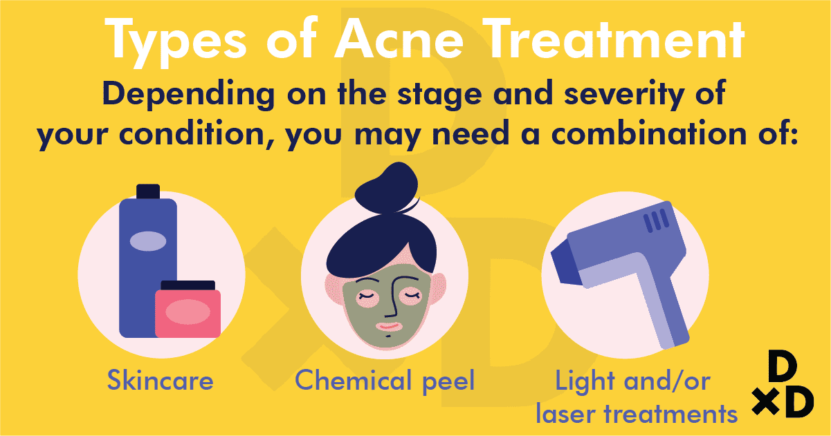 types-of-acne-treatment