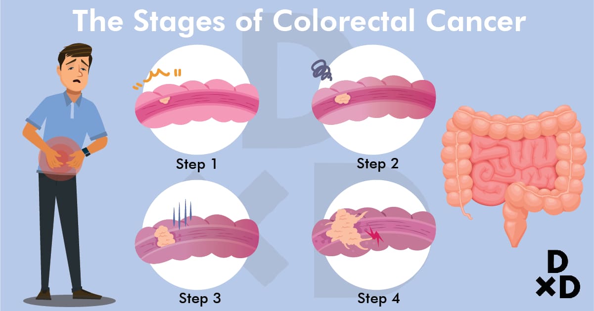 the-stages-of-colorectal-cancer