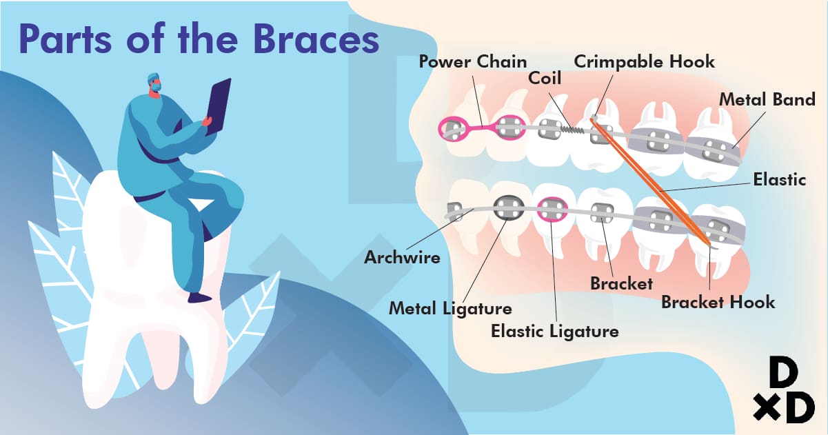 parts-of-the-braces