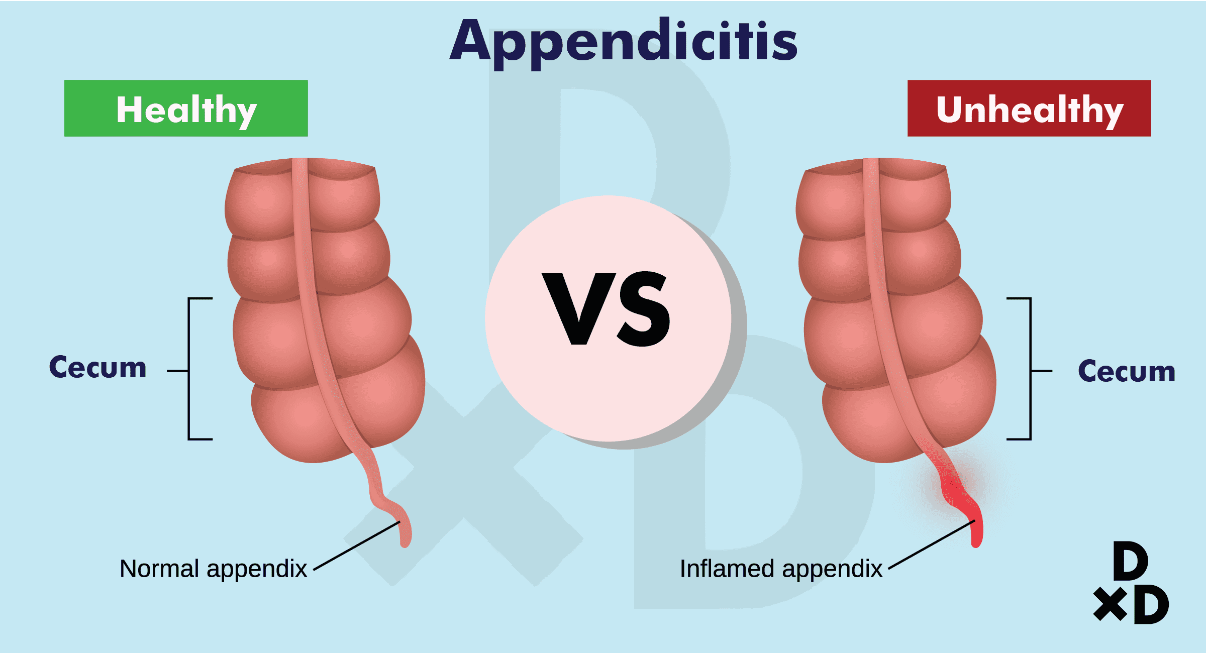 what-is-appendicitis