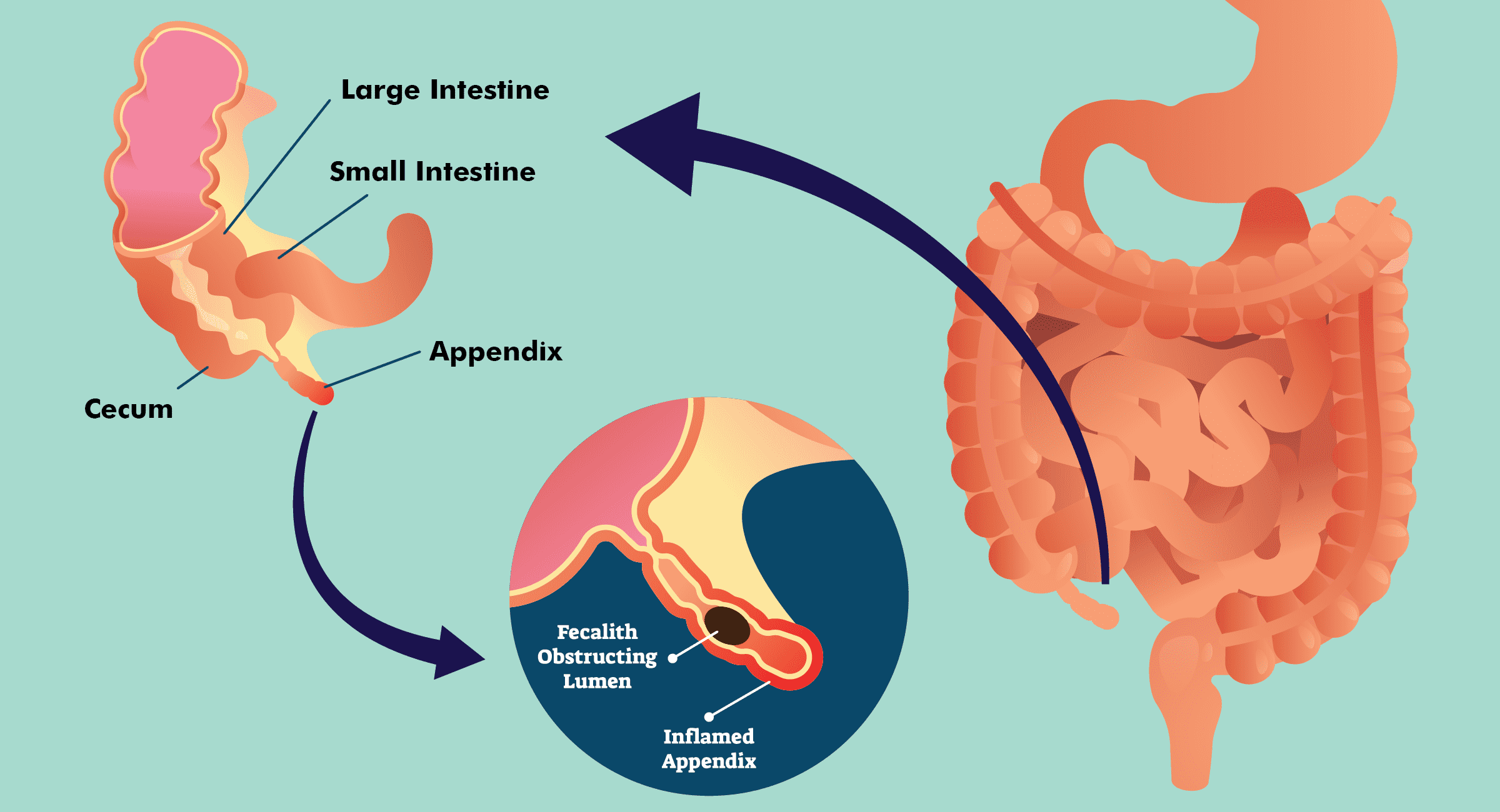 causes-appendicitis