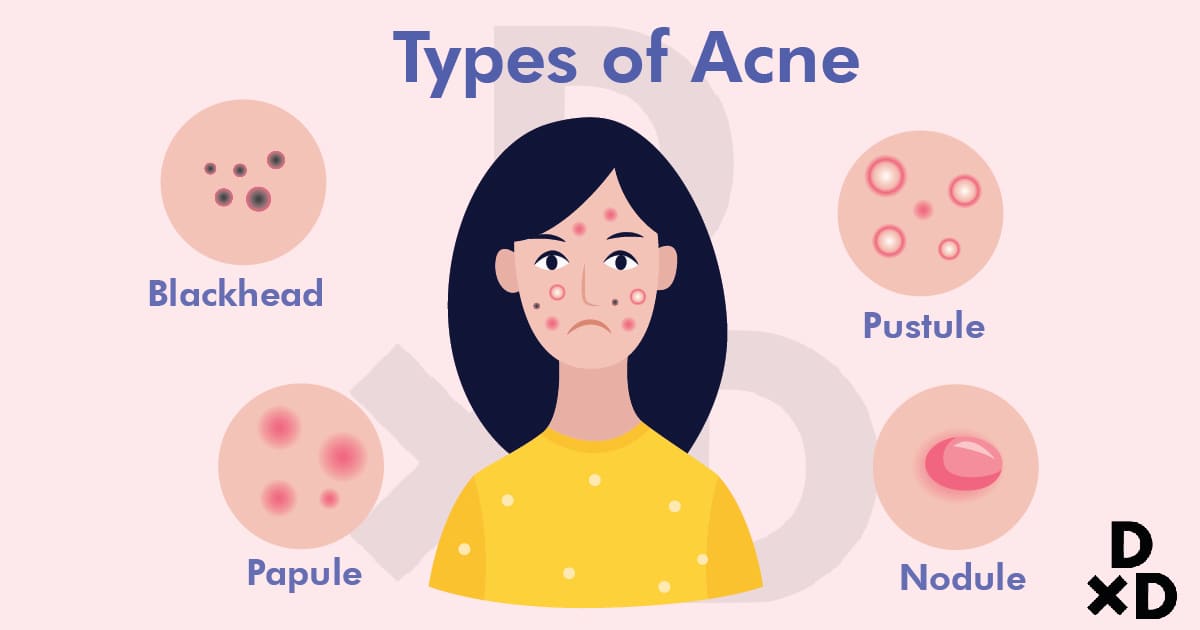 types-of-acne