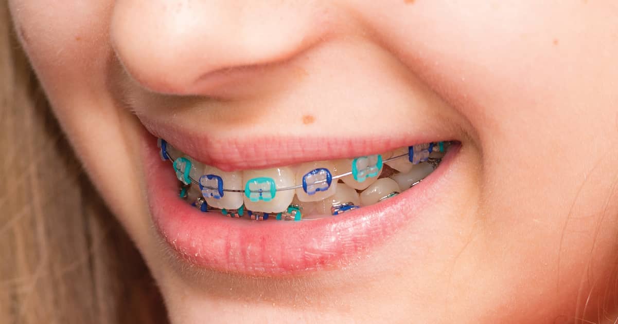 metal-braces