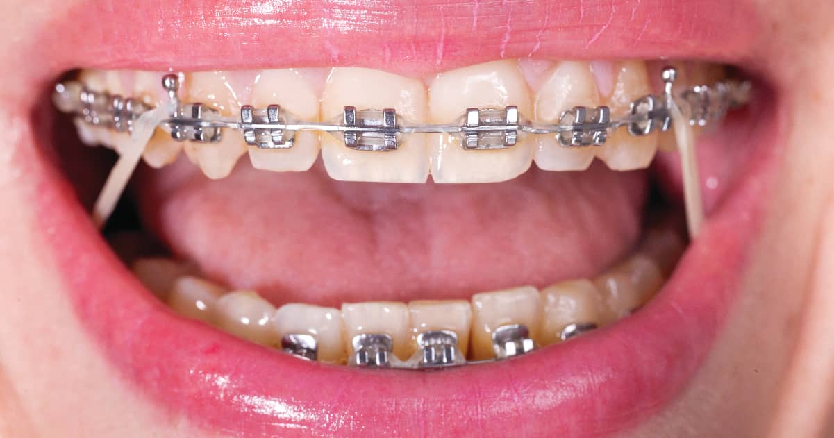 self-lingual-braces