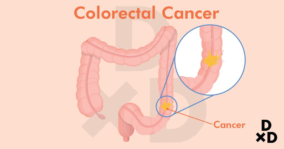 colorectal-cancer