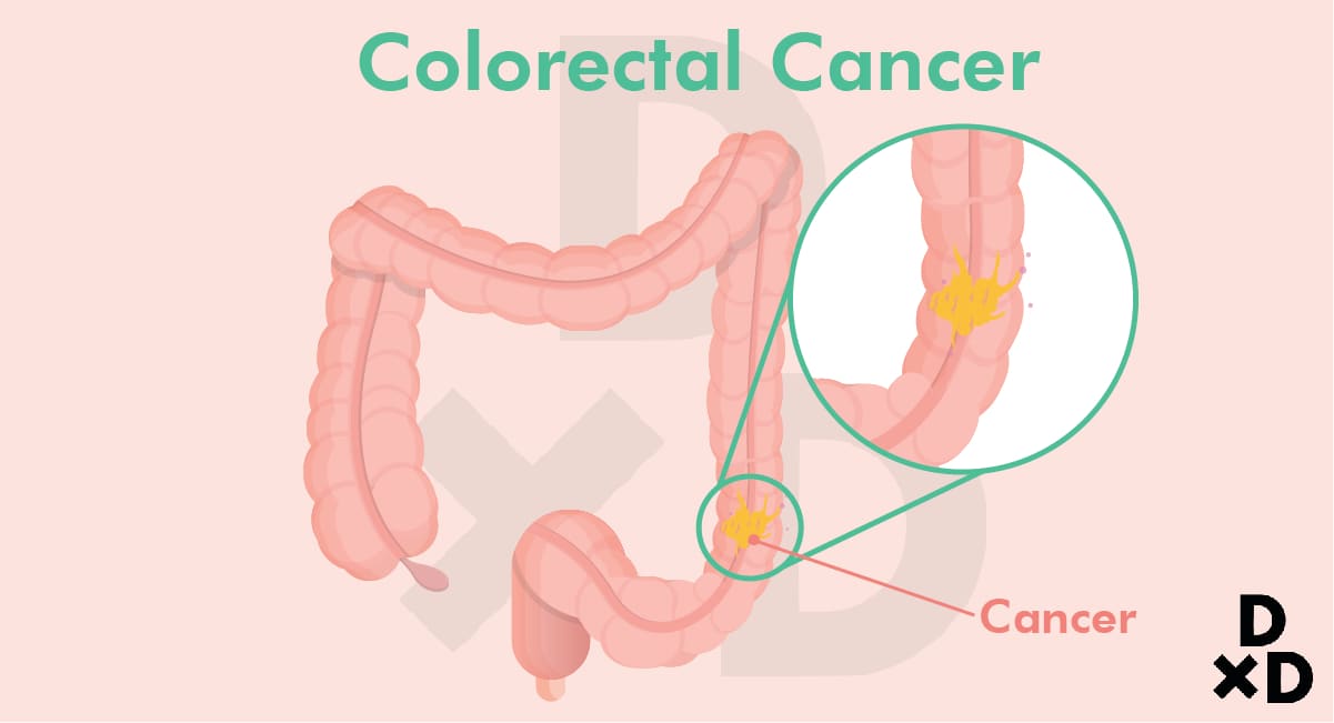 colorectal-cancer-100