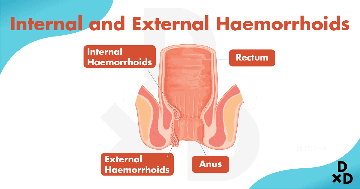 internal-external-haemorrhoids