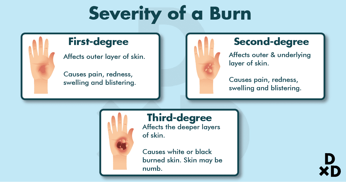 severity-of-burns-scars