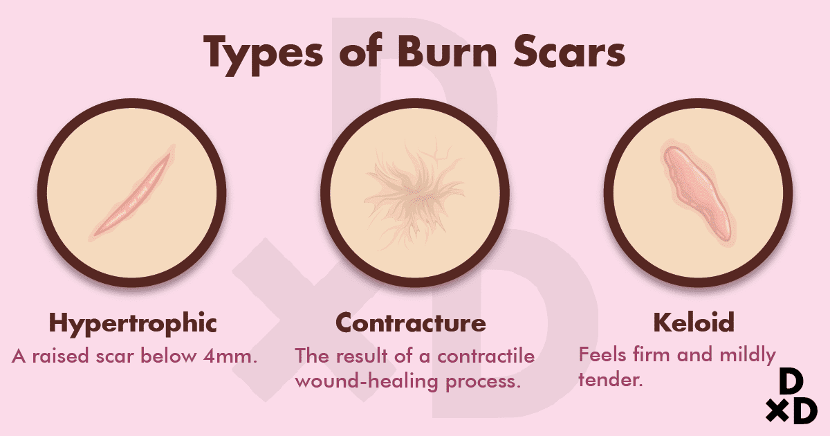 second degree burn scar prevention