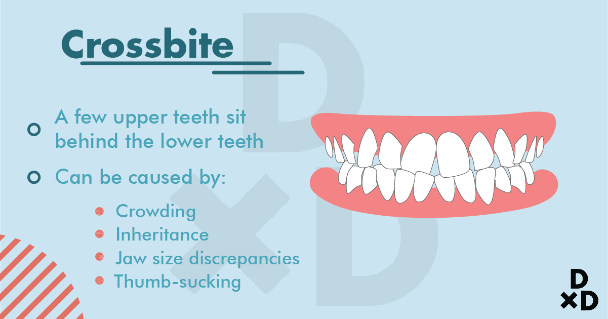 crossbite-dental-bites