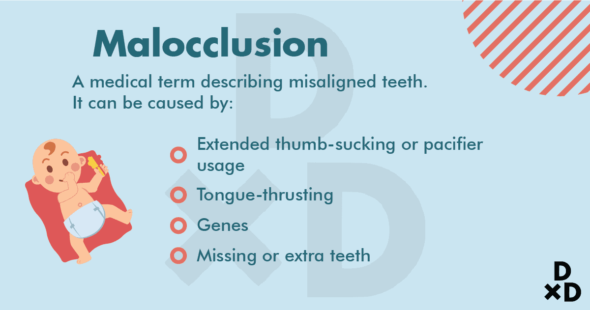 malocclusion-dental-bites