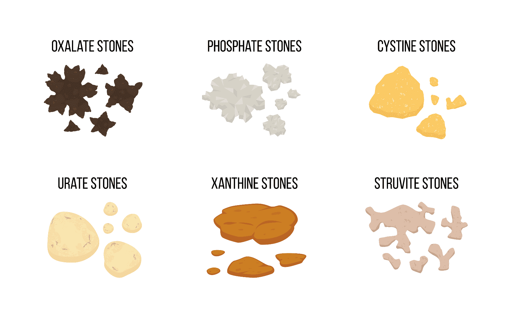 How Are Kidney Stones Formed