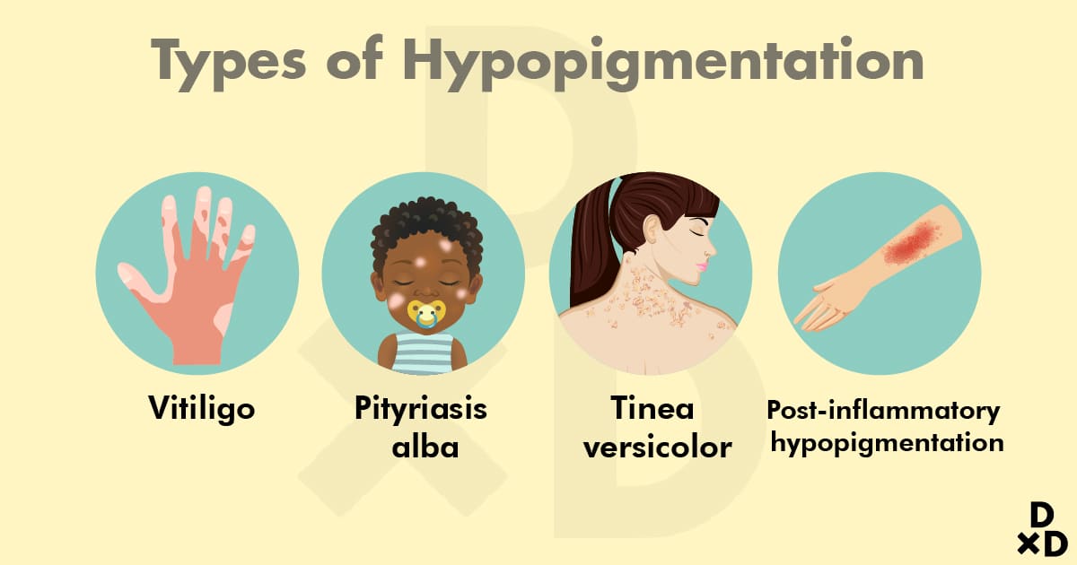 types-of-hypopigmentation