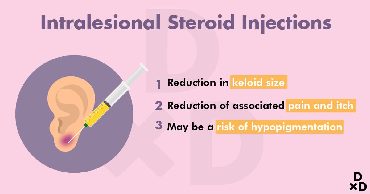 intralesional-steroid-injections