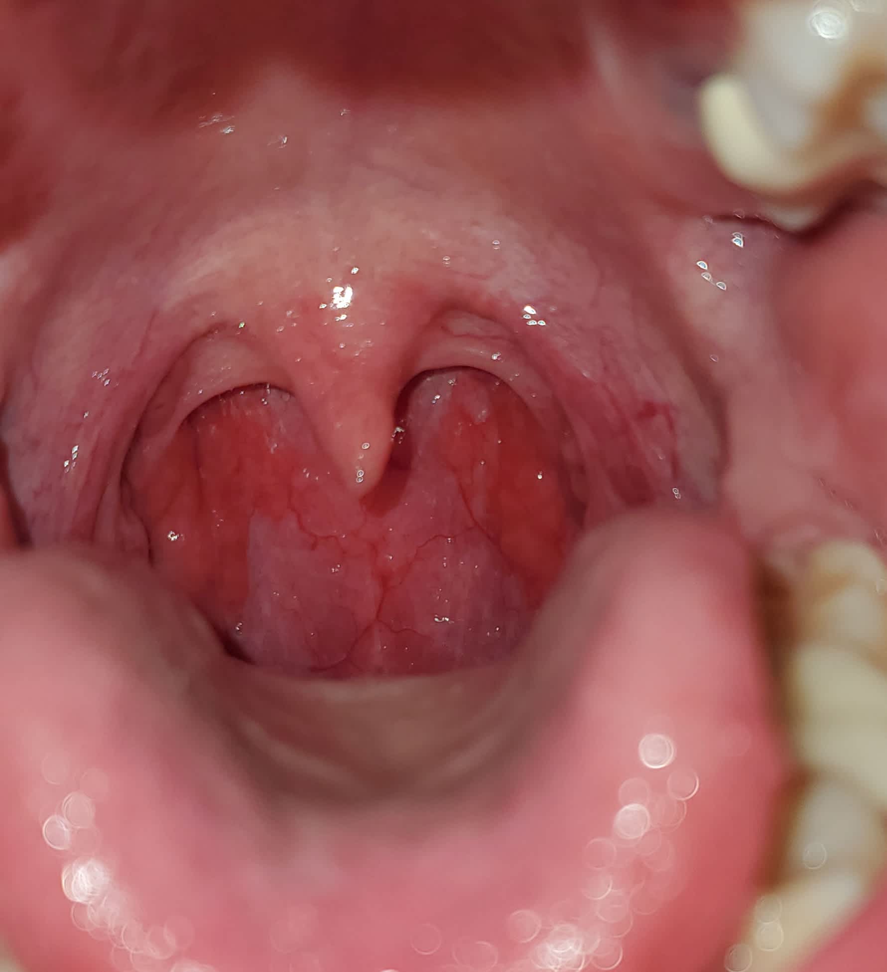 bumps on back of throat