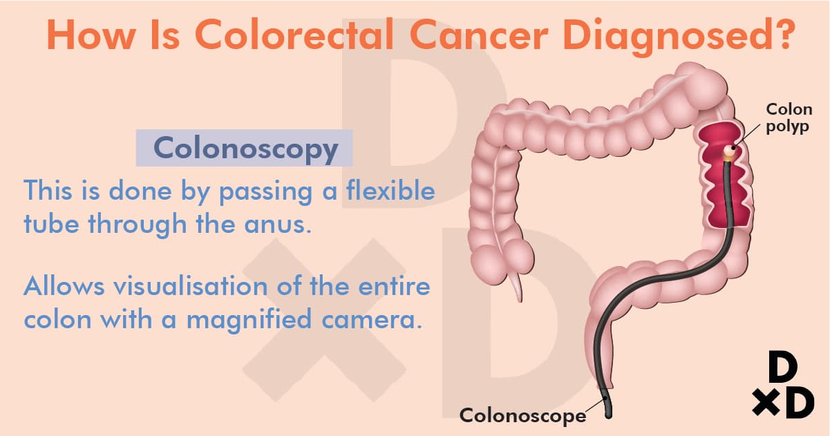 how-is-colorectal-cancer-diagnosed