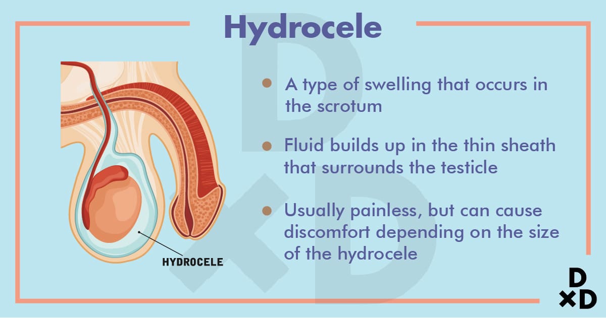 hydrocele-testicular-pain-causes