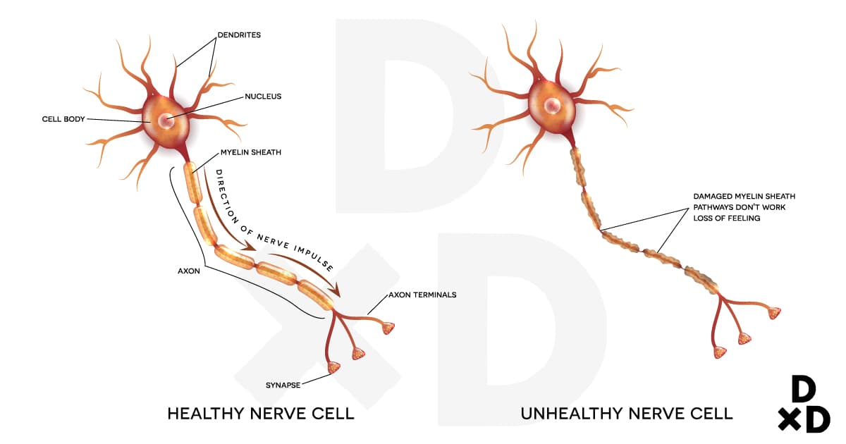 neuropathy