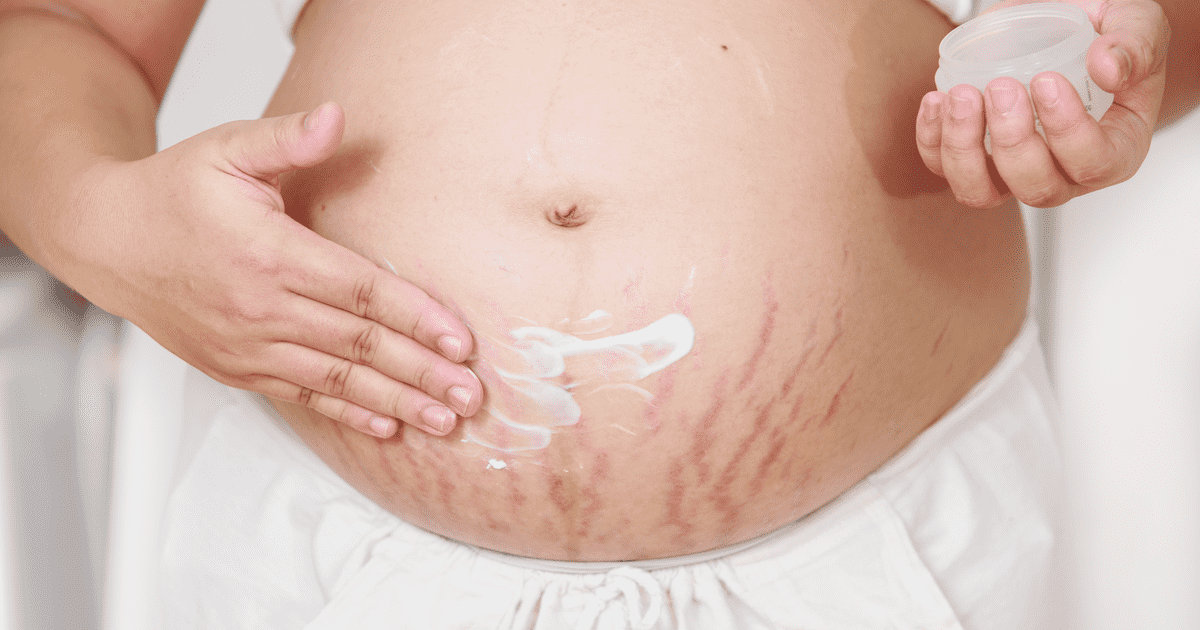 cream-stretch-marks-treatment